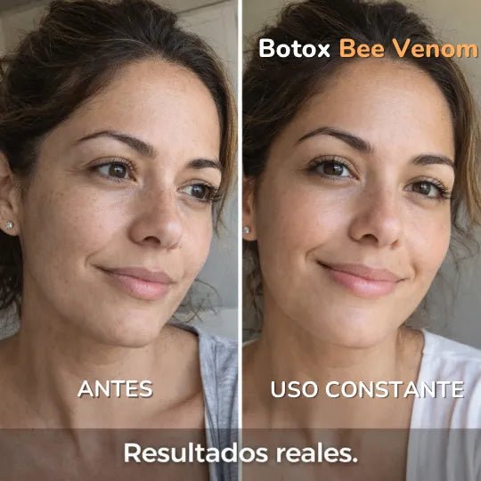 Botox Bee Venom - Pleyer