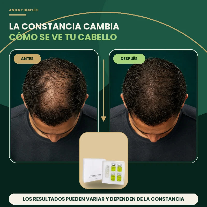 Antes y después de la apariencia de cobertura en la coronilla con Kit Capilar Pleyer