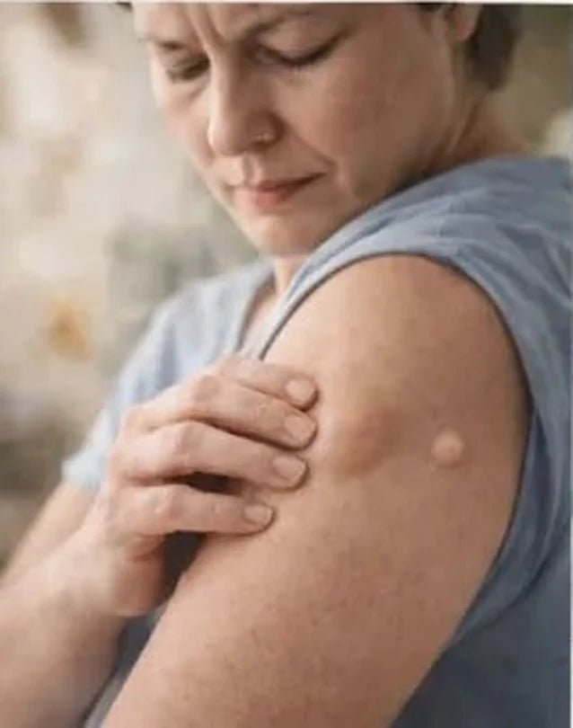 Persona observando un lipoma visible en su brazo antes de iniciar una rutina localizada
